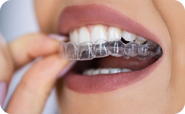 アライナーの写真