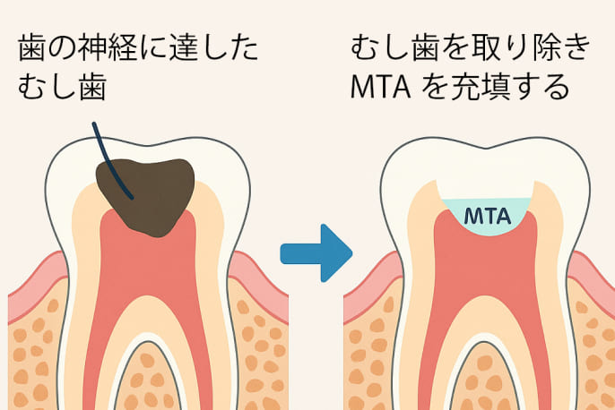 歯髄保存療法(MTA)