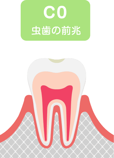 初期虫歯のイラスト