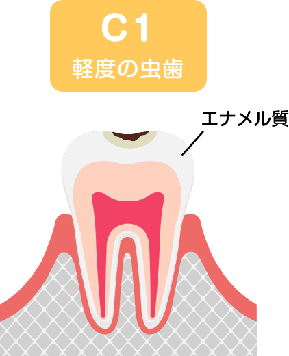 初期むし歯(C1)のイラスト