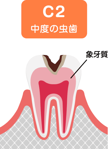 象牙質に達したむし歯(C2)のイラスト