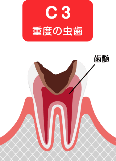 歯根まで達したむし歯(C4)のイラスト