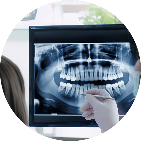 歯のレントゲン画像