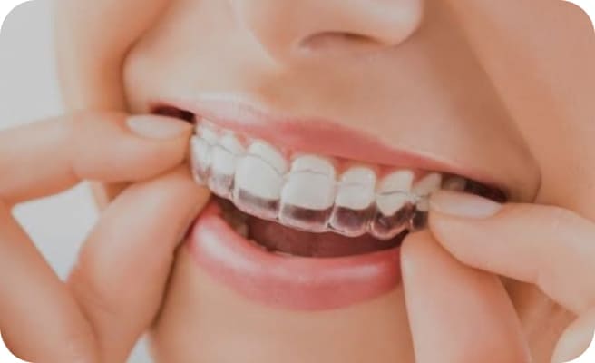 マウスピースをつけている様子