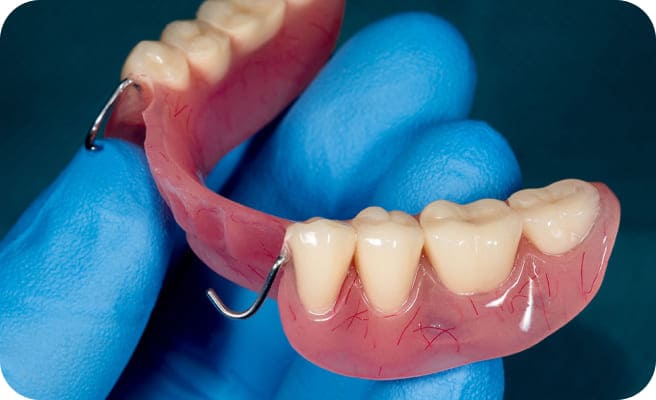 入れ歯の製作・装着の写真