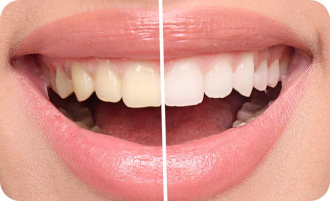 ホワイトニング前後の写真