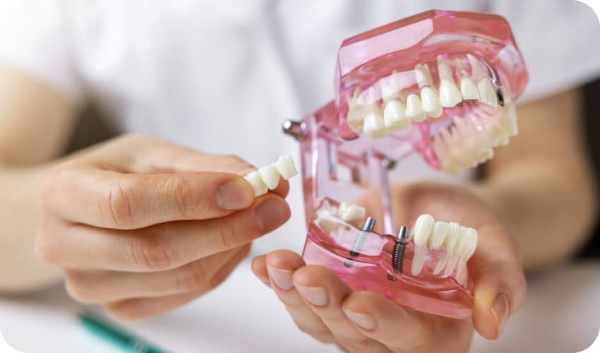 歯の模型の写真