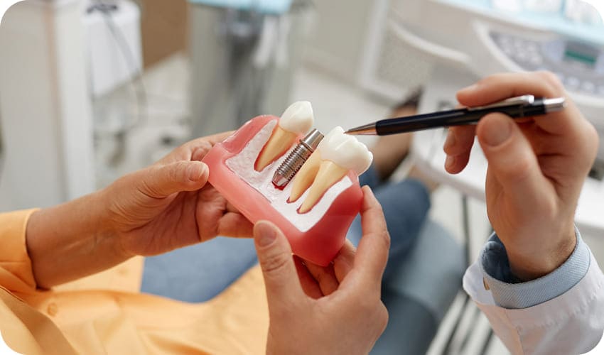 歯の模型の写真