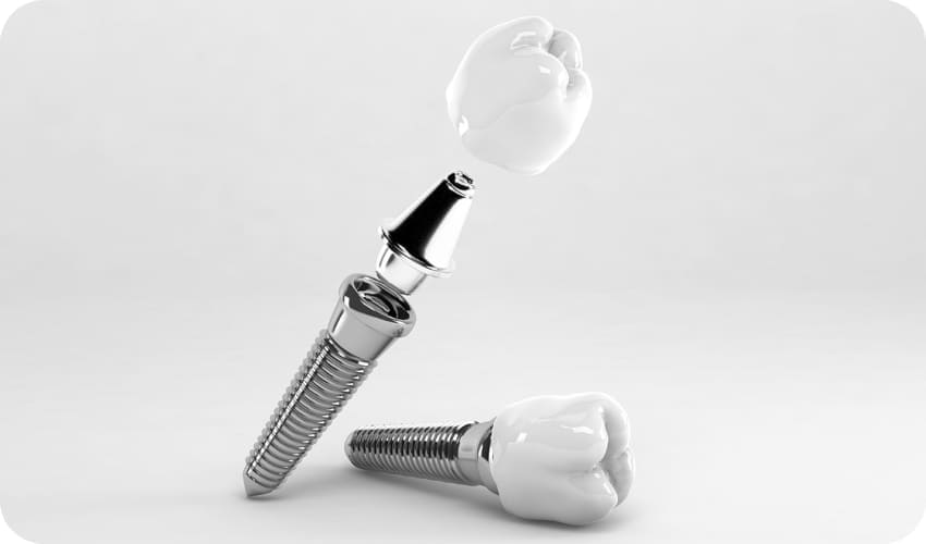 インプラント器具の写真