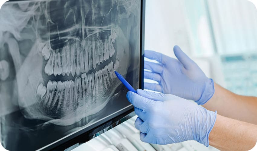 歯のレントゲンの写真